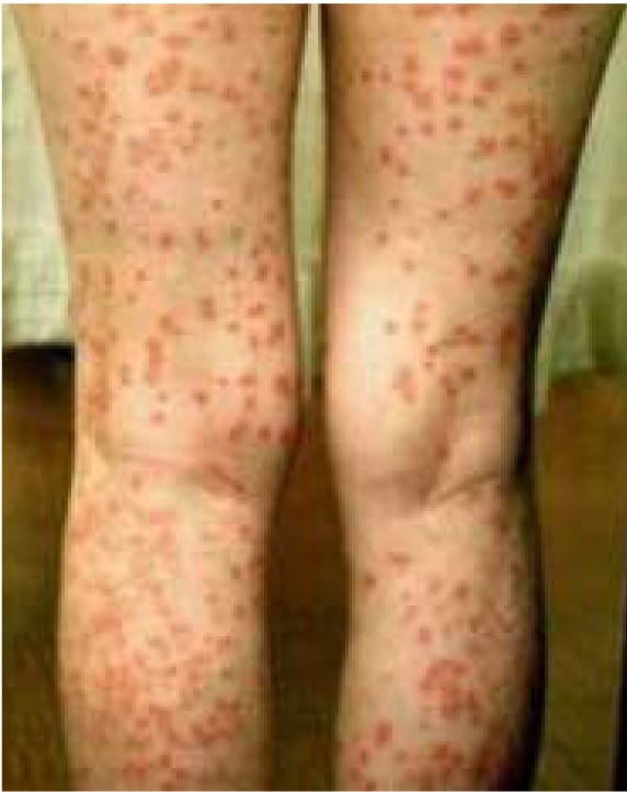 乾癬で赤い班点が多数ある下肢