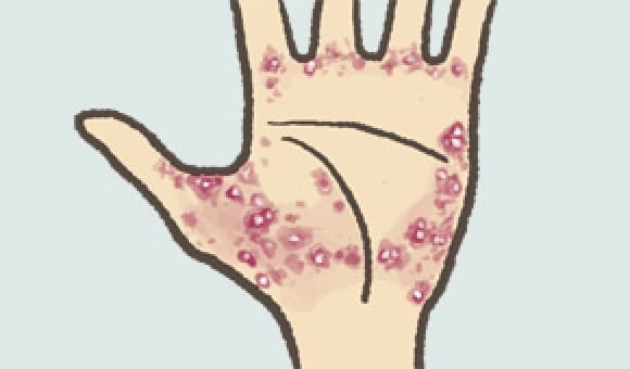 掌蹠膿疱症（しょうせきのうほうしょう）手のひら