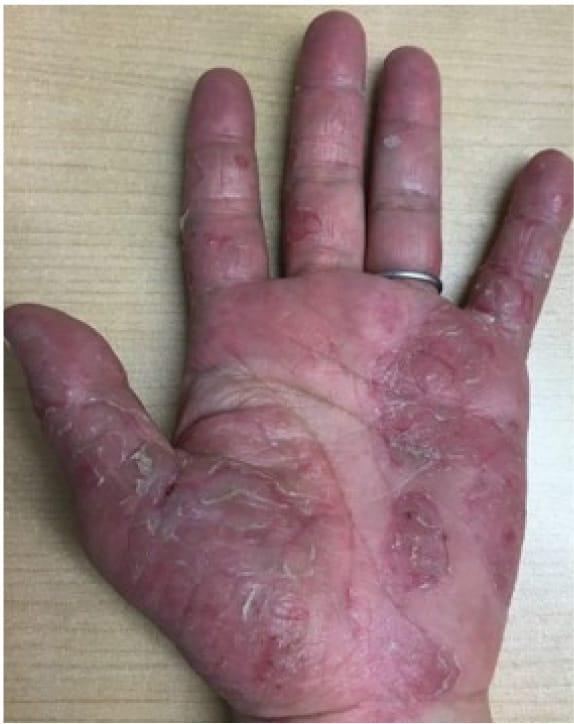 掌蹠膿疱症、乾癬、湿疹で赤く腫れ、荒れた掌