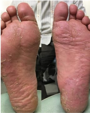 膿疱疹で赤く腫れ、荒れた足裏