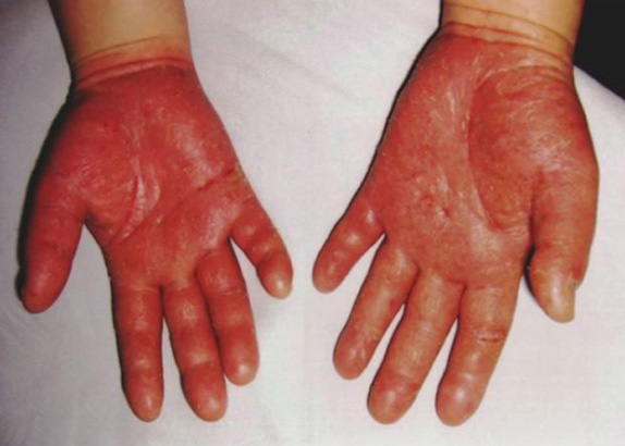 接触性皮膚炎（手のひら）